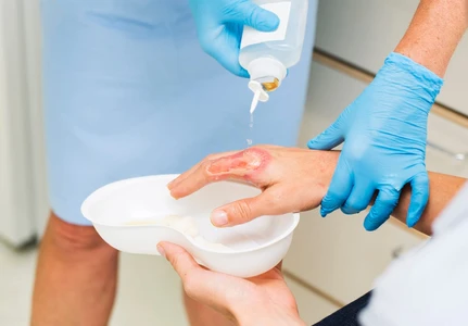 Dua Warga Korban Luka Bakar Erupsi Semeru Berangsur Pulih